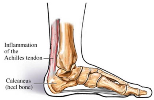 Achilles-tendon