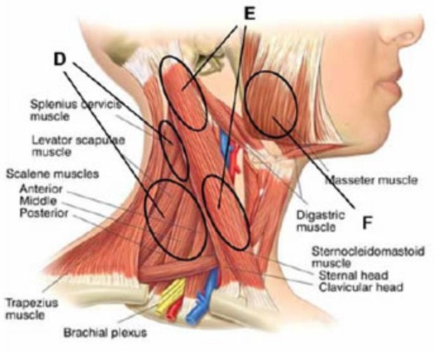 Acute-Torticollis