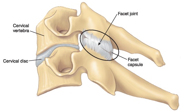 Facet-Syndrome