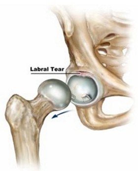 Hip-Labral-Tear