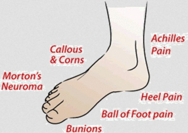 Morton's-Neuroma