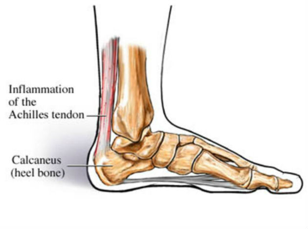 Ахиллит — причины, симптомы, все способы лечения
